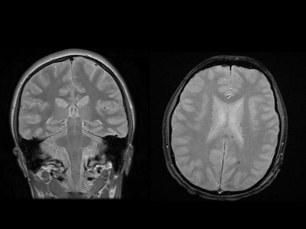 Fig. 11: Paciente varón de 19 años que sufrió un traumatismo craneo-encefalico severo en coma, con tac cerebral sin alteraciones.