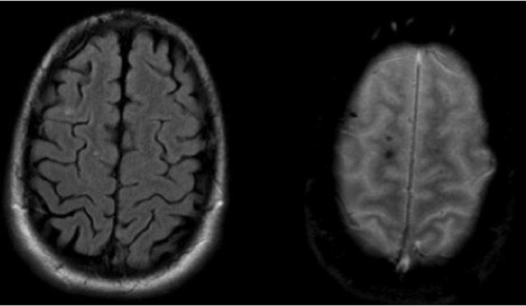 Fig. 12: Paciente varón de 19 años que sufrió un traumatismo craneo-encefalico severo en coma, con tac cerebral sin alteraciones. ( imagenes 11,12 y 13).