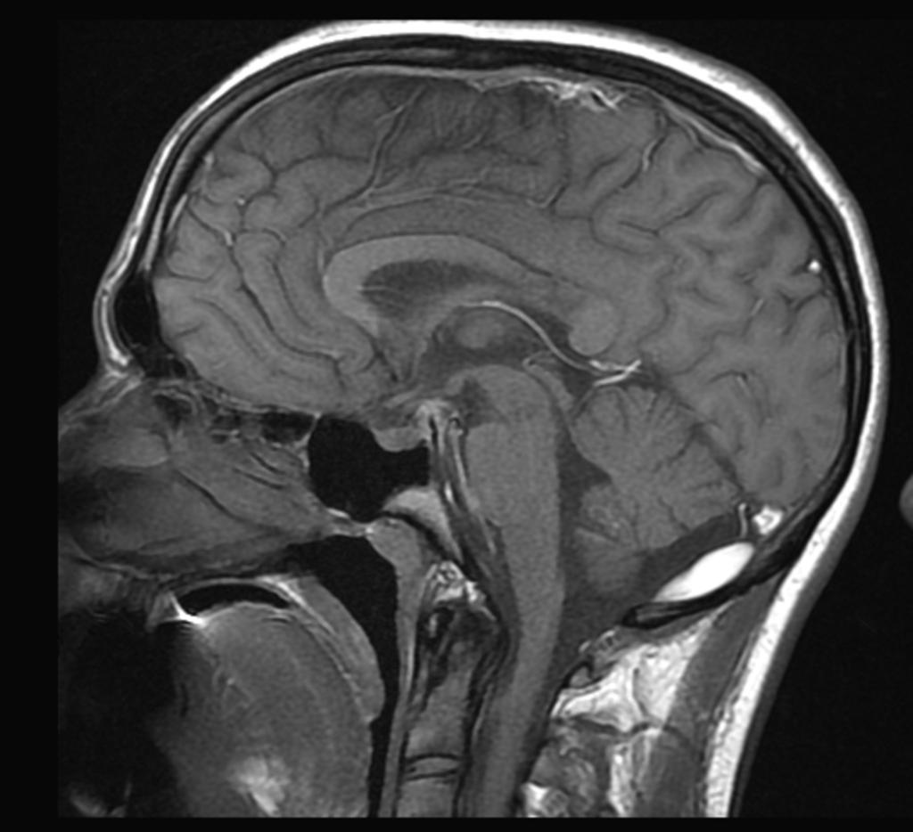 Fig. 13: Paciente varón de 19 años que sufrió un traumatismo craneo-encefalico severo en coma, con tac cerebral sin alteraciones. ( imagenes 11,12 y 13).