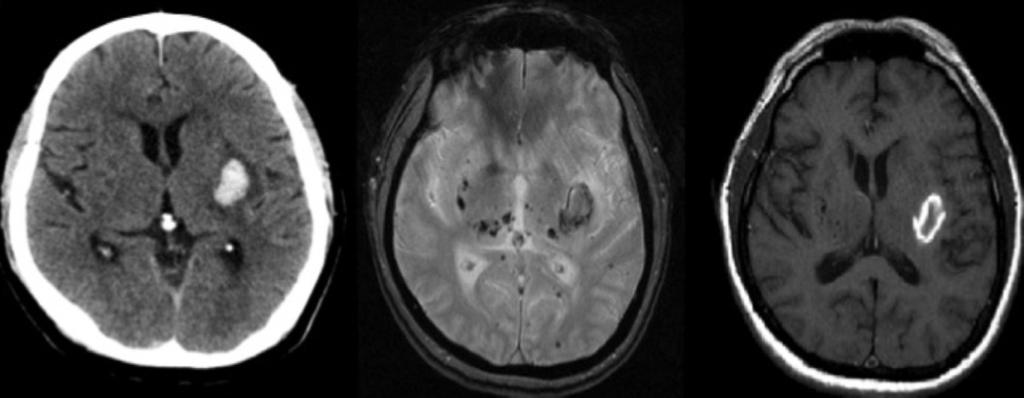 Fig. 14: Paciente de 54 años hipertenso crónico. (imagenes 14 y 15) En la imagen de TC se identifica un hematoma agudo en ganglios basales izquierdos.