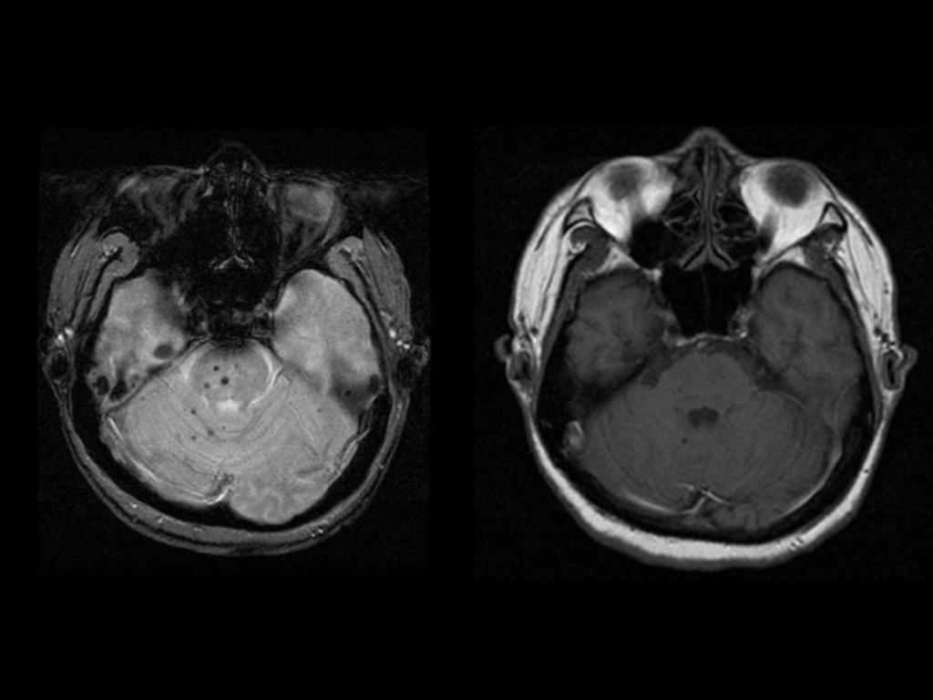 Fig. 15: Paciente de 54 años hipertenso crónico. (imagenes 14 y 15) En la imagen de TC se identifica un hematoma agudo en ganglios basales izquierdos.