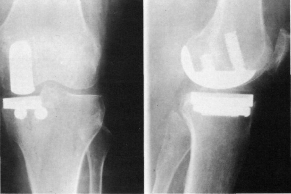 154 REVISTA ESPAÑOLA DE CIRUGÍA OSTEOARTICULAR Figura 2. Examen radiológico tres años después de la implantación de una prótesis monocondilar de «Böhler». La fijación se consigue sin utilizar cemento.