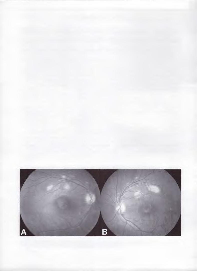 La distrofia en patrón es un trastorno macular hereditario que se caracteriza por la presencia de depósitos amarillentos a nivel del epitelio pigmentario retinal (EPR) sobre el área macular.