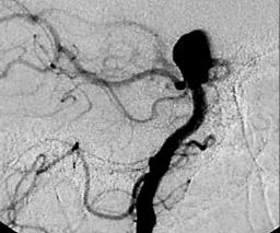 118 J. goland et al rev argent neuroc Fig. 3.. ngiografía con incidencia oblicua que muestra un aneurisma grande con cuello pequeño del cual nacen ambas arterias cerebrales posteriores.