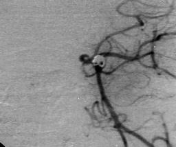 Prevalence of asymptomatic incidental aneurysms: review of 4,568 arteriograms. Stroke 1983; 14: 121 (abstract). 4. tkinson JLD, Sundt TM Jr, Houser OW, Whisnant JP.