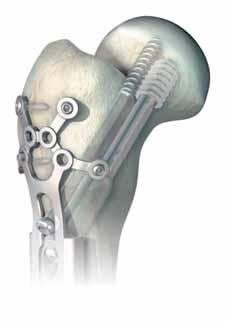 Ventajas de la estabilidad angular Evita que los tornillos se aflojen Mejora el anclaje en el hueso osteoporótico Posibilita la inserción de tornillos monocorticales Como fijador interno, la