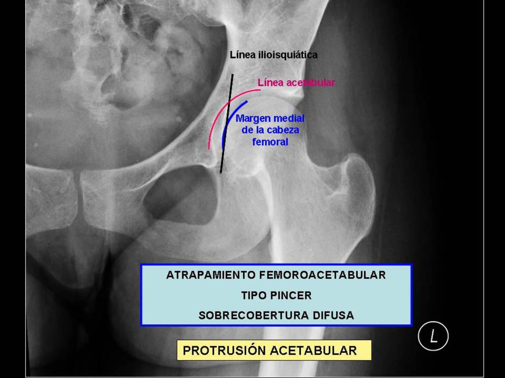 Fig. 6: AFA tipo pincer.