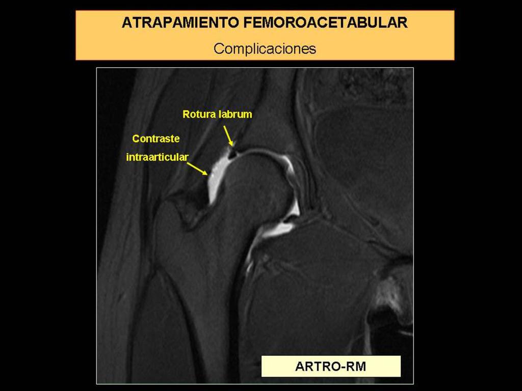 Fig. 15: Artro-RM. Imagen coronal.