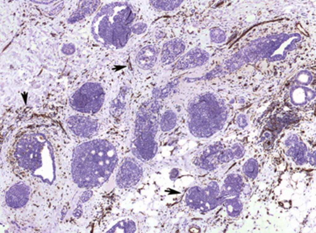 Fig. 6: Tinción inmunohistoquímica de microvasos con anticuerpo anti-cd31.