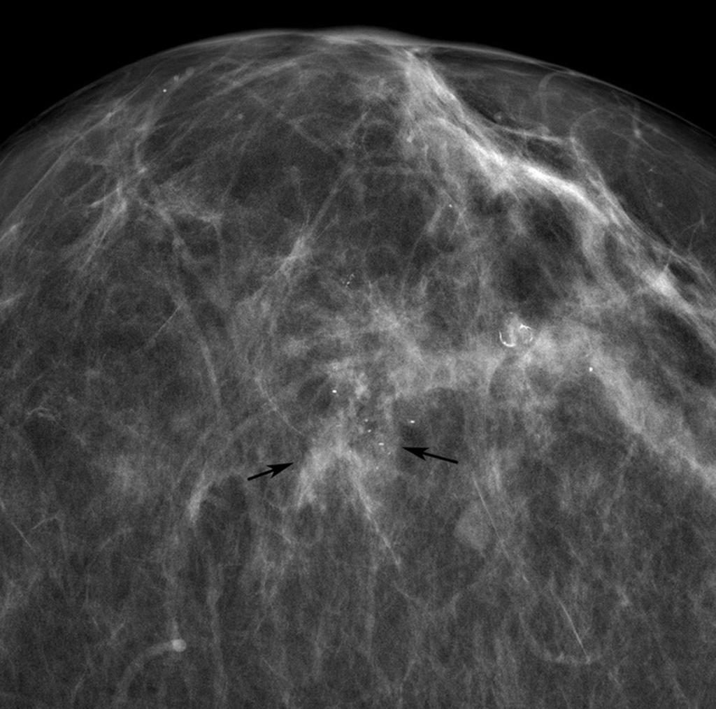 Fig. 1: Paciente de 65 años con CDIS de grado 3. Mamografía. Proyección craneocaudal.