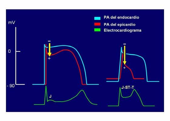 demostrado una mayor sensibilidad del epicardio isquémico en la activación de la corriente IK ATP, lo que sugiere que este efecto (acortador de la DPA) contribuya a su mayor vulnerabilidad frente a