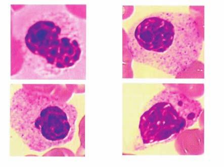 Anomalías morfológicas de los leucocitos en el niño 667 Figura 2. Las mielodisplasias en el niño son escasas.