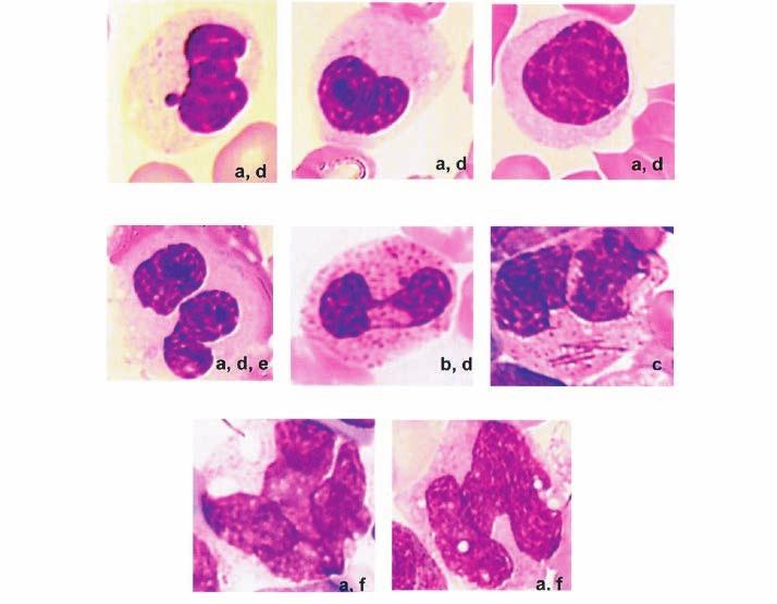Los polinucleares neutrófilos tienen un núcleo poco lobulado con cromatina fragmentada y condensada. lisosomal, esencialmente en el curso de mucopolisacaridosis (MPS) (4).