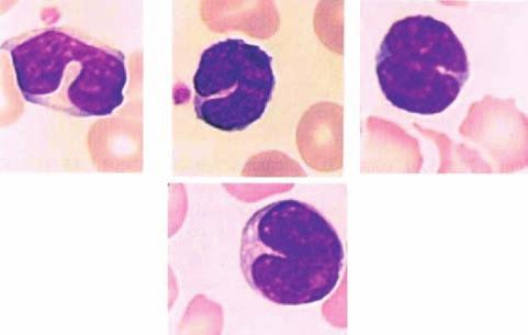 En el curso del síndrome mononucleósico son numerosas las células mononucleadas hiperbasófilas. Su aspecto es heterogéneo en tamaño, intensidad de basofilía y en textura de la cromatina.