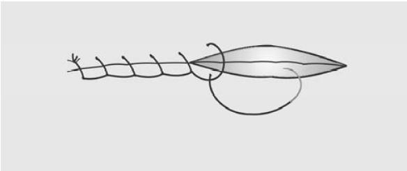 b) Sutura continua anclada o surgete anclado. Similar a la anterior, pero antes de tirar del asa formada se pasa la sutura por la misma. c) Sutura subdérmica.
