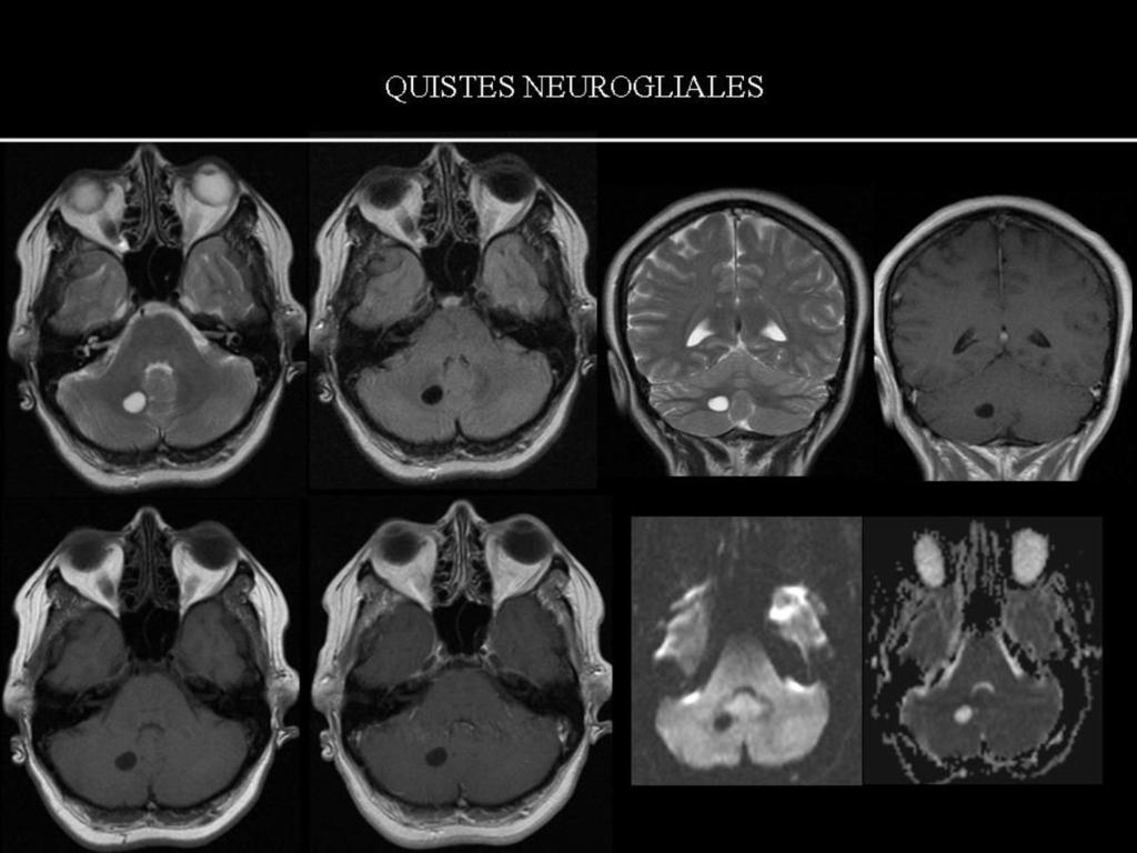 Fig. 8: Paciente de 50 años a la que se le realiza RM craneal por estudio de cefalea, como hallazgo se aprecia un lesión quística bien definida, cerebelosa derecha, sin efecto de masa y