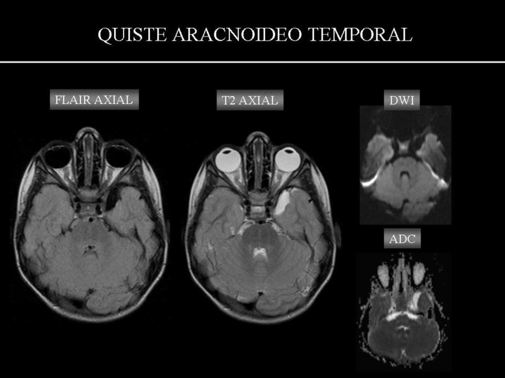 Fig. 16: QUISTE ARACNOIDEO TEMPORAL (mismo paciente, niño de 3 años con rasgos de déficit cognitivo y del aprendizaje): lesión de pequeño tamaño extra-axial, temporal