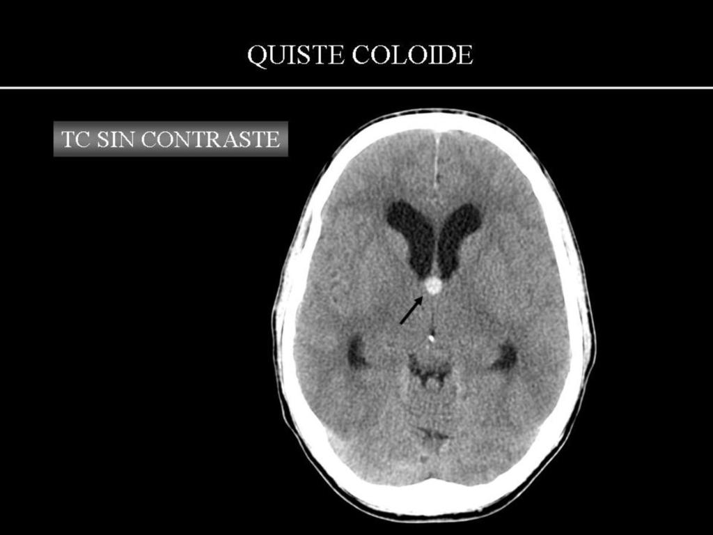 Fig. 18: QUISTE COLOIDE: paciente de 30 años remitido por neurología con clínica de hipertensión intracraneal.