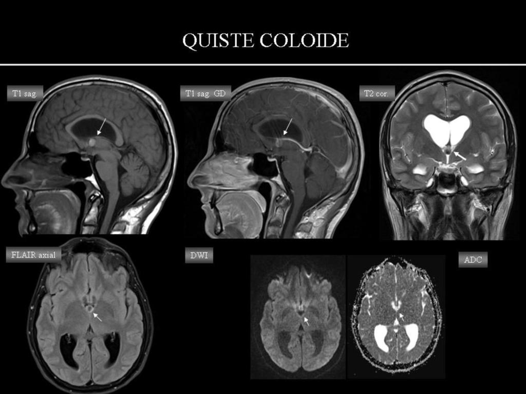 Fig. 19: QUISTE COLOIDE: mismo paciente que en la figura anterior, en RM se visualizó una lesión bien definida localizada en el III ventrículo (flechas blancas), hiperintensa en T1, sin realce con