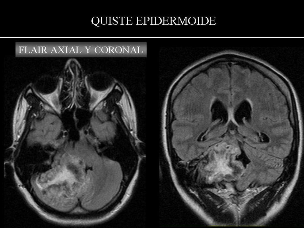 Fig. 23: QUISTE EPIDERMOIDE DE FOSA POSTERIOR: mujer de 26 años con clínica de cefalea y vértigos.