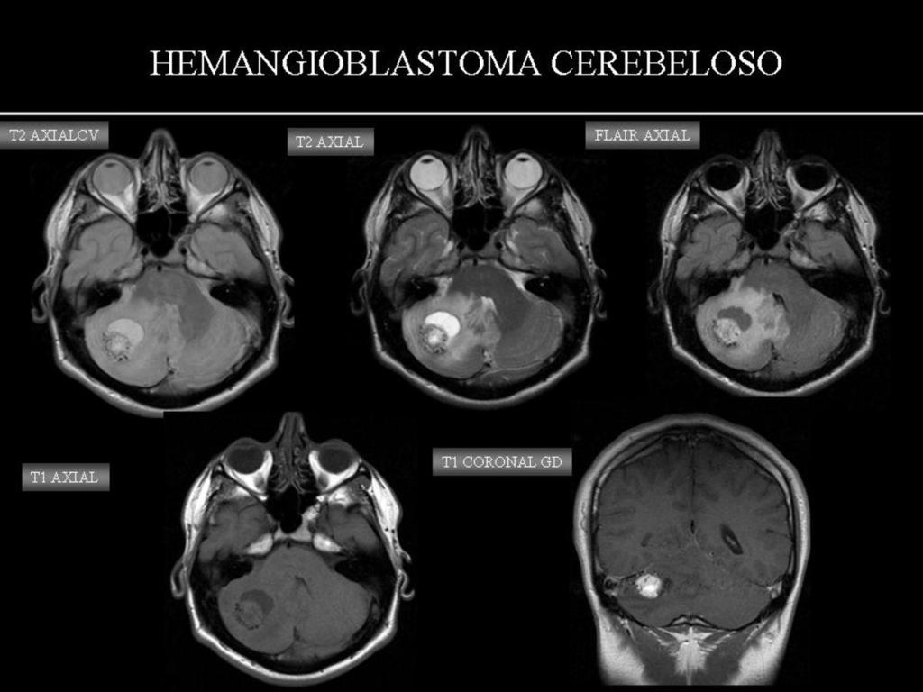 Fig. 33: HEMAGIOBLASTOMA CEREBELOSO: paciente de 18 años con cefalea de 1 año de evolución que aumentaba con las maniobra de valsalva.