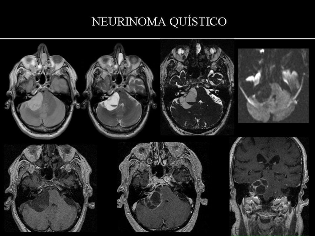 Fig. 36: NEURINOMA QUÍSTICO (RM DP, T2 CISS, DWI, T1 sin y Gd y T1 coronal con Gd):paciente de 80 años con dolores cervicales, inestabilidad en la marcha, pérdida de sensibilidad en cara derecha y