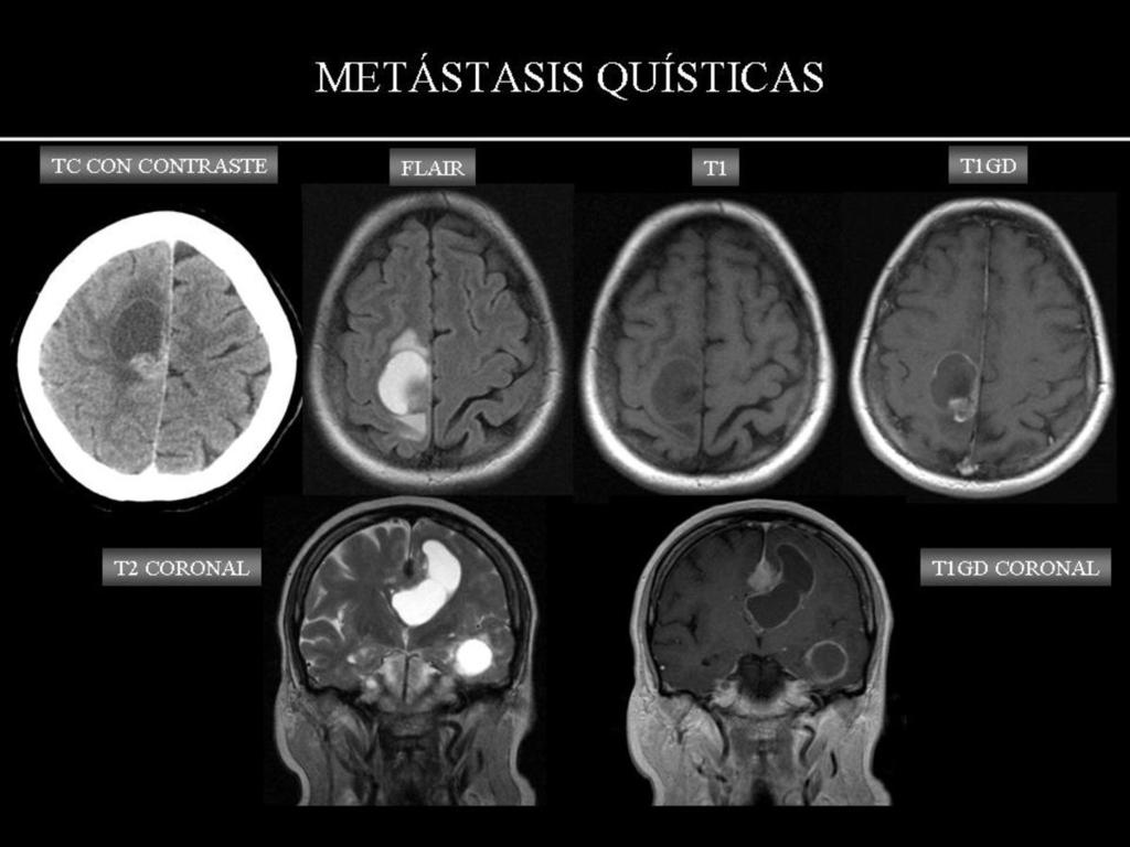 Fig. 37: METÁSTATIS QUÍSTICAS, en dos pacientes diferentes: la fila de arriba muestra una metástasis única en la convexidad frontal derecha con importante edema vasogénico, realce en anillo y nódulo