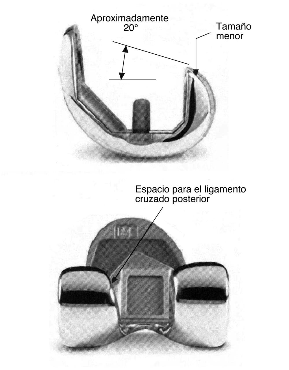 Sección Figura 5 Fotografías de diversas modificaciones de los diseños de las prótesis para permitir mayor flexión.
