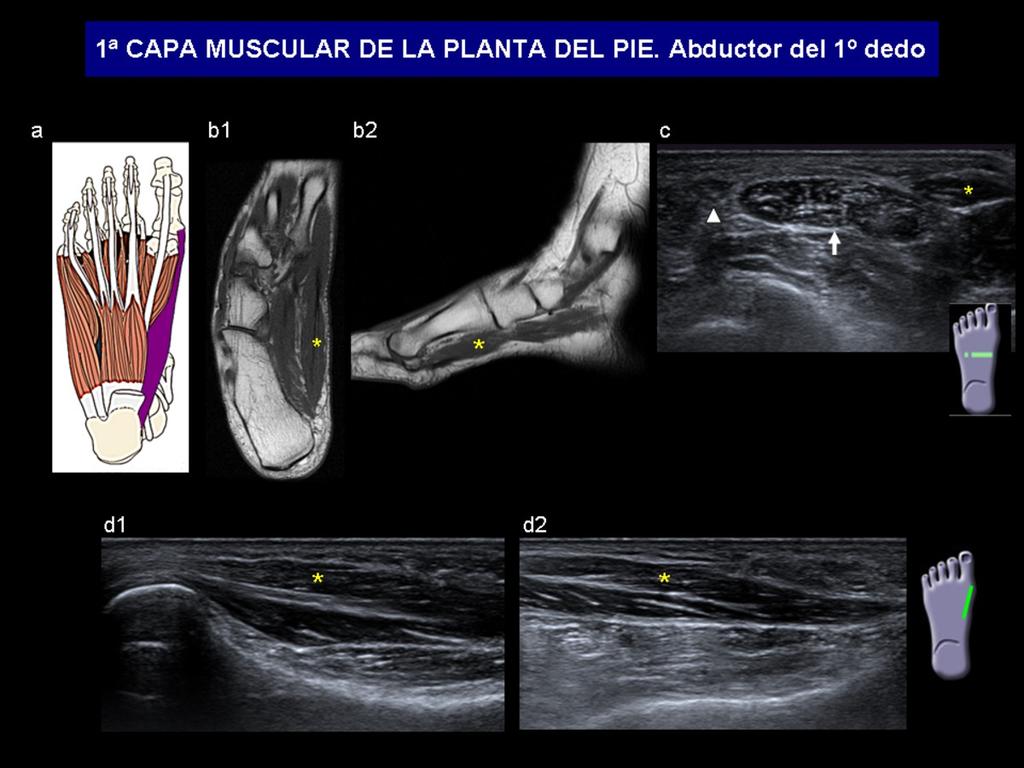 Fig. 7: a) Diagrama anatómico con el recorrido del músculo abductor del 1º dedo (morado). b) RM T1 axial (b1) y sagital (b2) del pie, donde se observa el abductor del 1º dedo (asterisco).