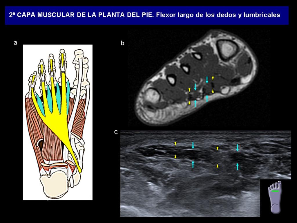 Fig. 11: a) Diagrama anatómico y el equivalente corte axial de RM T1 del pie (b) y Ecografía (c), donde se observan los tendones del FLD (amarillo) hipointensos en