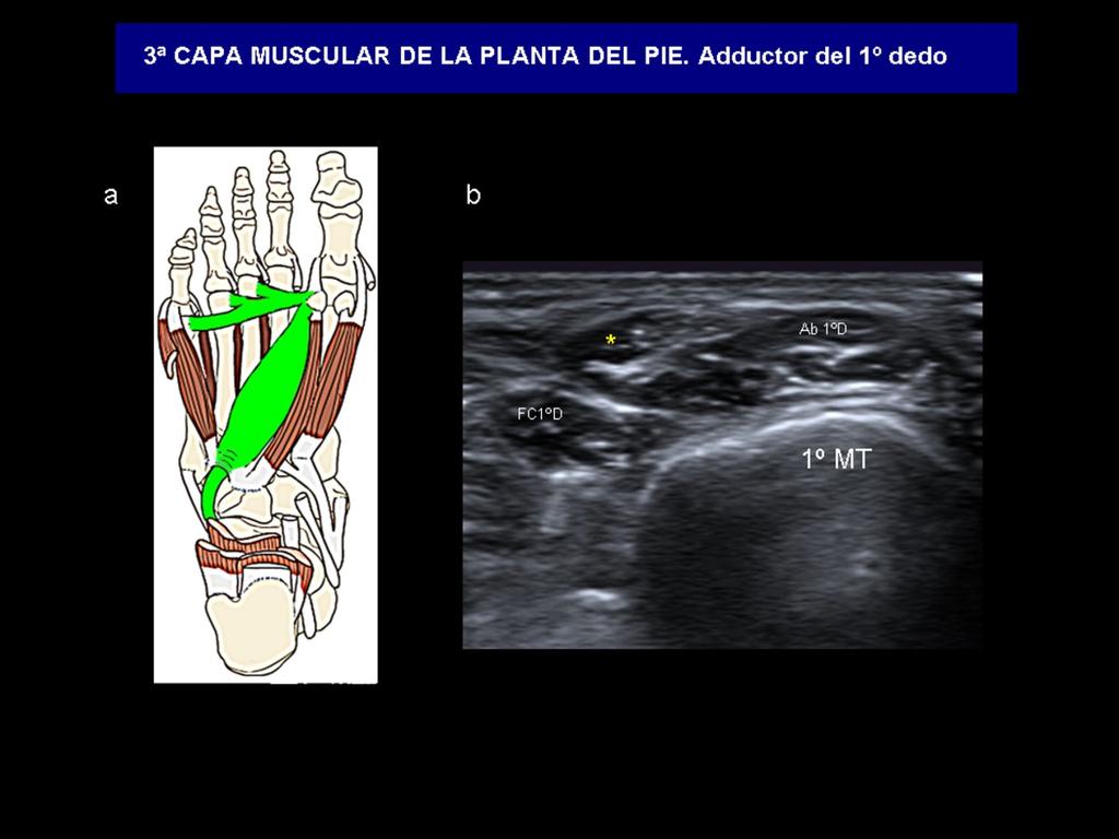 Fig. 13: a) Diagrama anatómico con la cabeza oblicua y transversa del adductor del 1º dedo (verde).