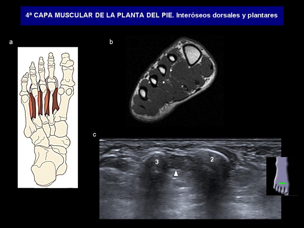 Fig. 15: a) Diagrama anatómico con los músculos interóseos dorsales (marrón oscuro) y plantares (marrón claro).