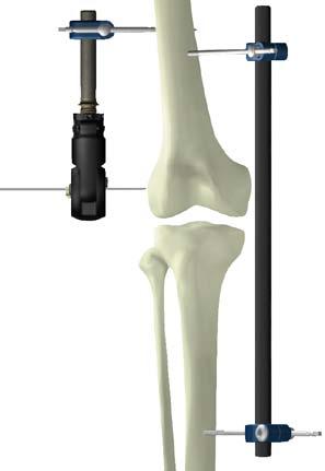 Fig. 4 Utilizando el berbiquí introducir el primer tornillo óseo proximal en la vertiente femoral, en posición mediana respecto a la diáfisis, utilizando el perno como guía (en caso de corticales