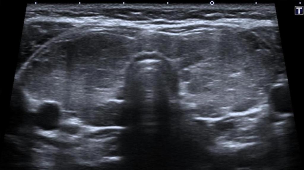 multiples micronódulos hipoecoicos de 1 a 6mm. En la figura b, se observa aumento del tamaño de los ganglios linfáticos látero-cervicales.