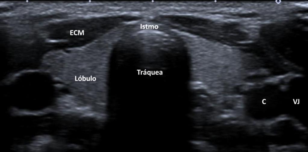 Fig. 1: Tiroides normal. Ecografía, sección transversal.