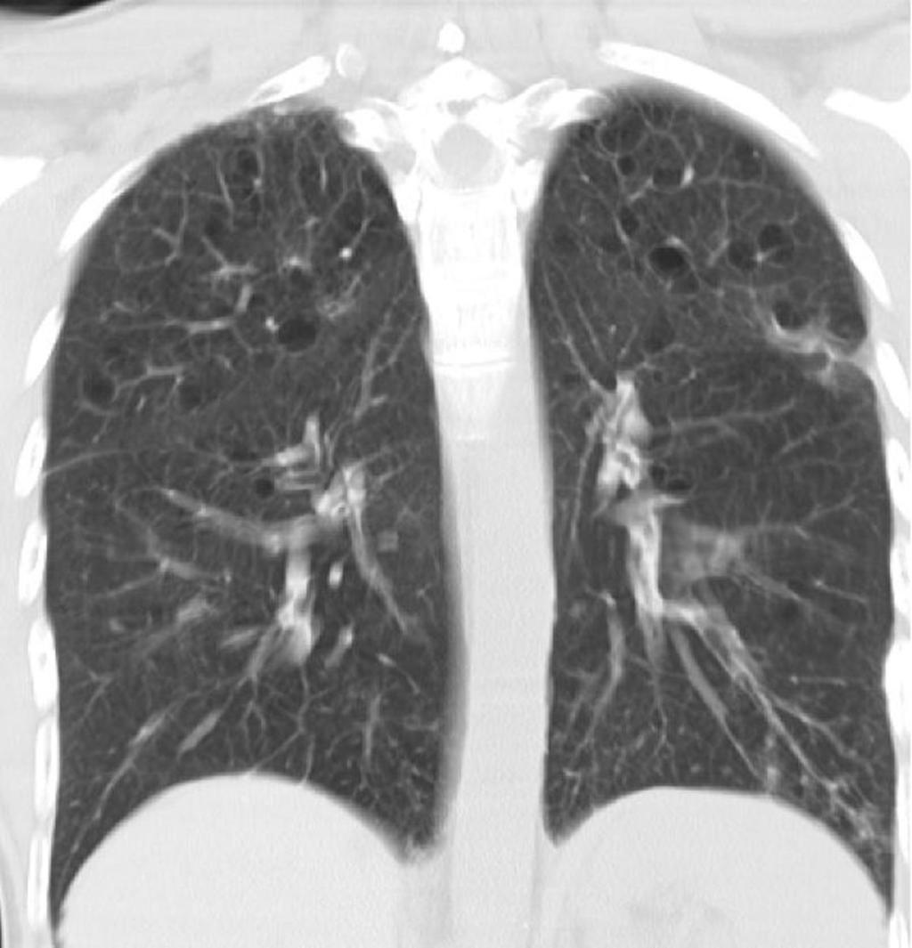 Fig. 7: Imagen coronal en paciente con afectación de lóbulos superiores por histiocitosis y
