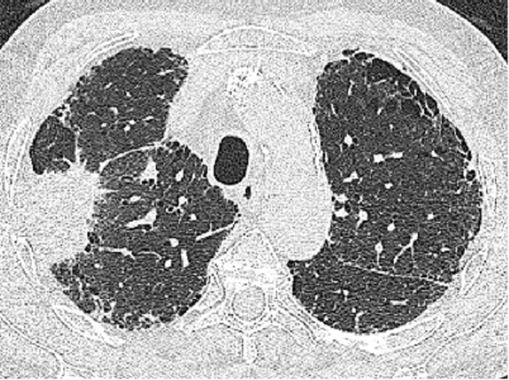 un carcinoma epidermoide pulmonar(cabeza de flecha) y presentaba derrame pleural derecho (estrella). Fig.
