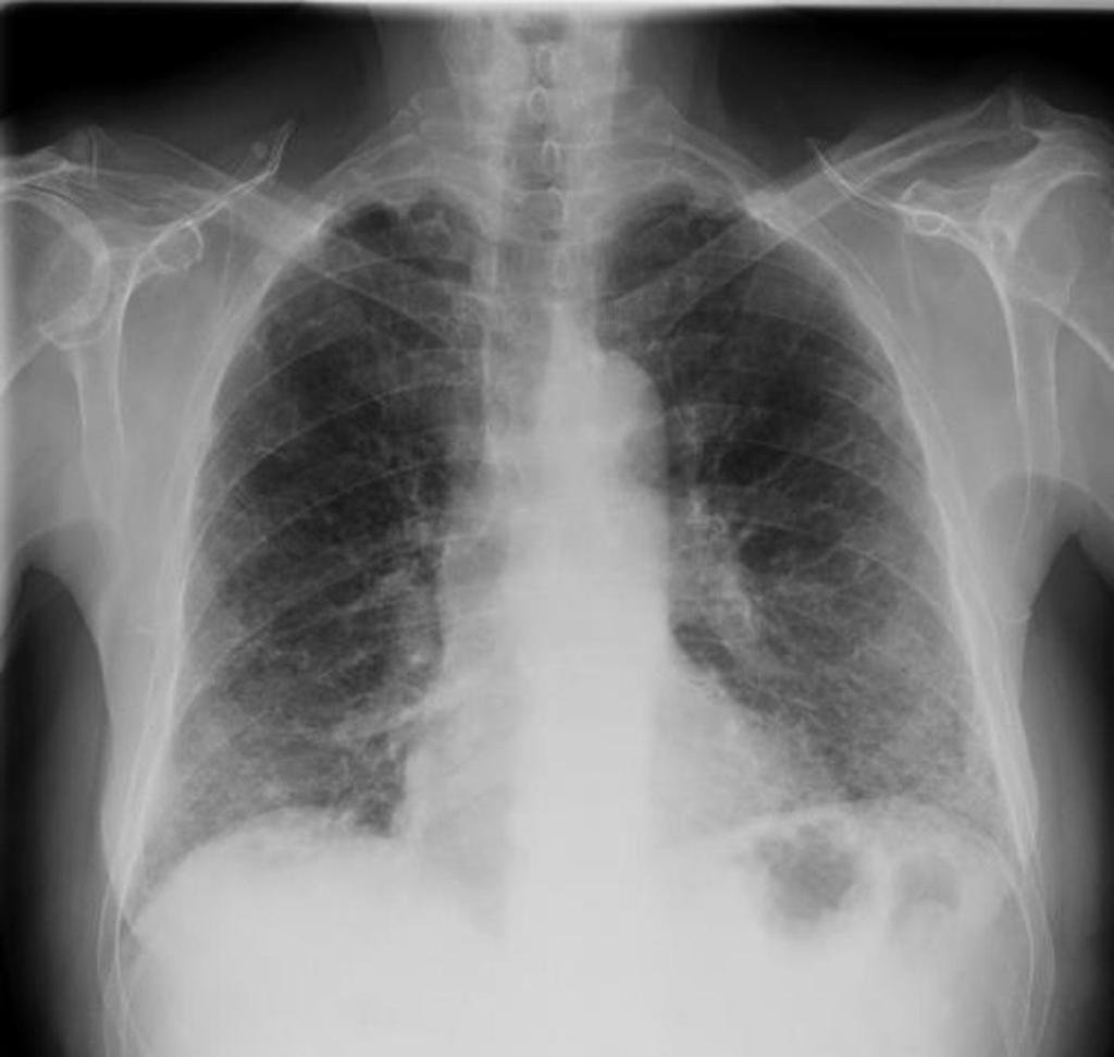 Fig. 12: Radiografía PA de tórax de un paciente fumador de más de 30 paquetes-año, donde se