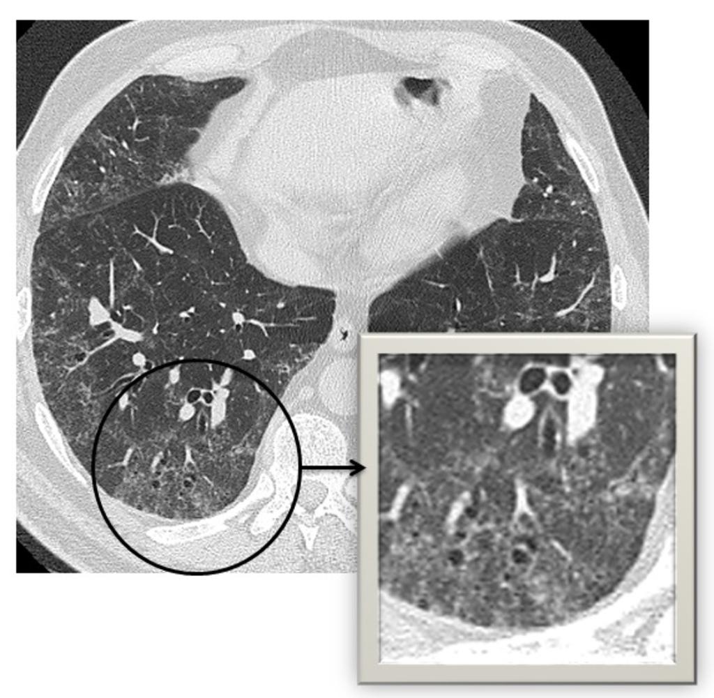 Fig. 1: Paciente con bronquiolitis respiratoria asociada al tabaco.