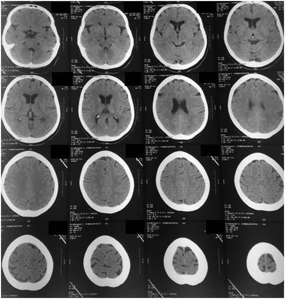122 angiográficos (Figura 4), con perfusión angiográfica (Figura 5), obteniéndose una clara reperfusión imagenológica cerebral, con TICI (thrombolysis in
