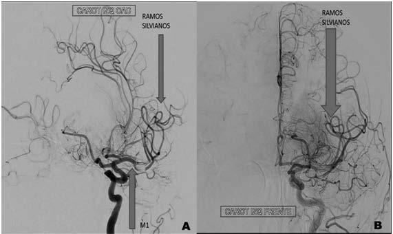 Con el hallazgo angiográfico de oclusión proximal vascular del sector anterior del polígono de Willis, con menos de 2 horas de evolución desde el inicio de