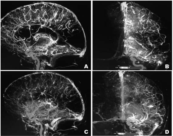 123 Figura 5. a. Estudio de flujo-perfusión angiográfica pre trombectomía; b. perfil y frente; c. Post-trombecotmia; d. perfil y frente, con clara mejoría en la reperfusión imagenológica.