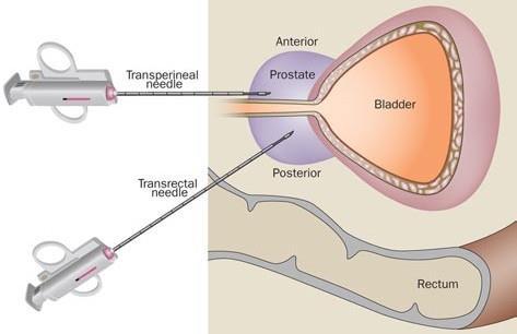 biopsia de prostata transperineal pdf