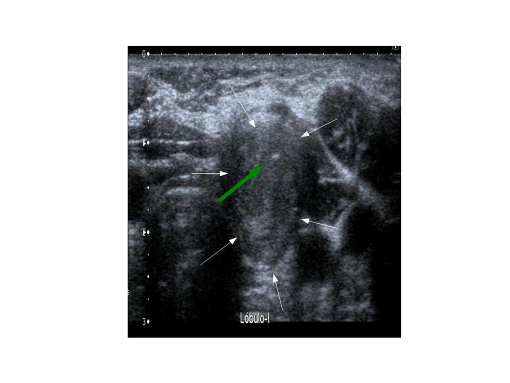 Fig. 4: Nódulo solido de más de 1 cm en lobulo tiroideo izquierdo (flechas blancas.