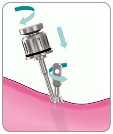 Seleccionar el diámetro y la angulación del los pilares ME en función de la angulación y de la plataforma del implante.