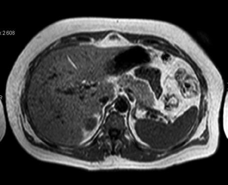 Páez Granda D. et al. Lesiones ocupantes Figura 19. Resonancia magnética hepática potenciada en T1, corte axial. Paciente femenina de 35 años, asintomática.