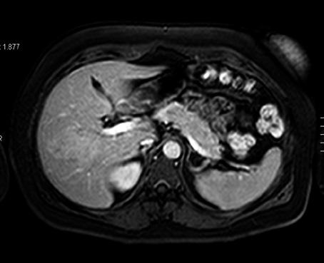 Lesiones ocupantes Páez Granda D. et al. Figura 22. Resonancia magnética hepática luego de la administración de contraste intravenoso, fase venosa precoz. Misma paciente que en el caso anterior.
