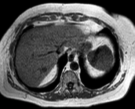 Lesiones ocupantes Páez Granda D. et al. (2) (Figura 6). Un nódulo en un hígado cirrótico con realce en fase arterial y eliminación en fase venosa, es específico de HCC.