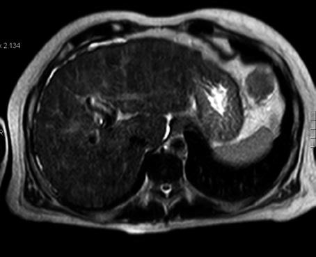 Lesiones ocupantes Páez Granda D. et al. Figura 6. Resonancia magnética hepática potenciada en T2, corte axial. Mismo paciente del caso anterior.