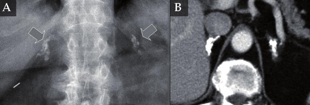 IMÁGENES DE LA TUBERCULOSIS URINARIA Figura 10. A. Radiografía simple de abdomen. B. TC con contraste.